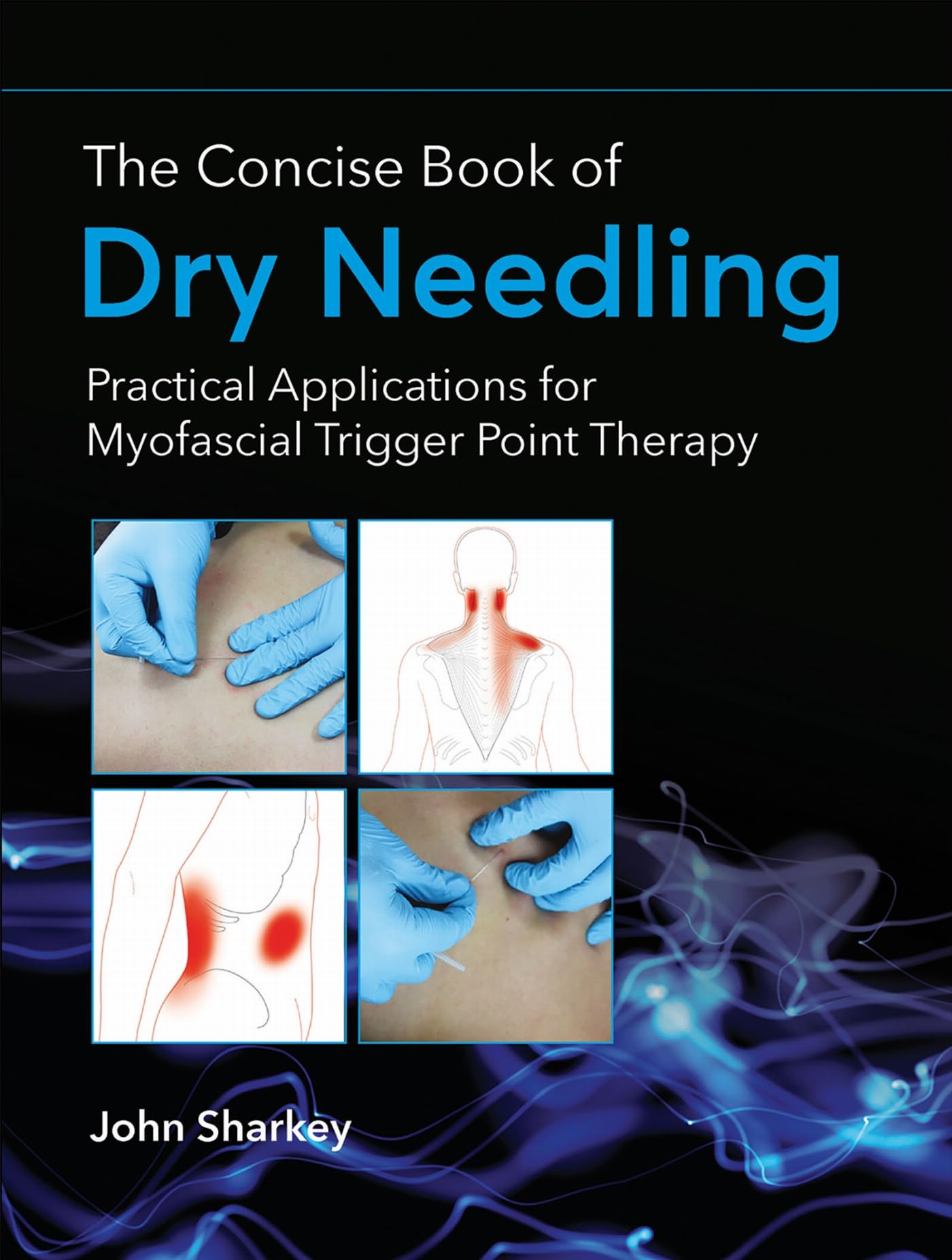 Cover of The Concise Book of Dry Needling: A Practitioner's Guide to Myofascial Trigger Point Applications