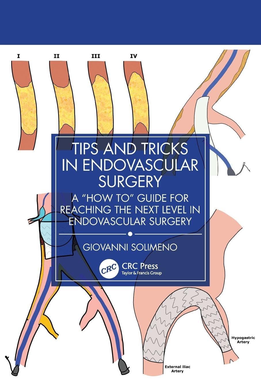 Cover of Tips and Tricks in Endovascular Surgery: A "How to" Guide for reaching the next Level in Endovascular Surgery