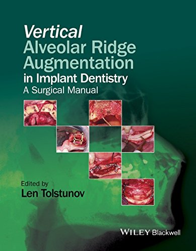 Cover of Vertical Augmentation of the Alveolar Ridge in Implant Dentistry