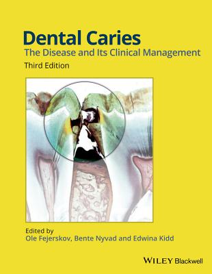 Cover of Dental Caries: The Disease and its Clinical Management