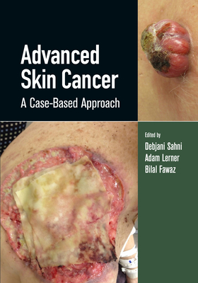 Cover of Advanced Skin Cancer: A Case-Based Approach