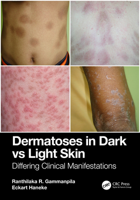 Cover of Dermatoses in Dark Vs Light Skin: Differing Clinical Manifestations